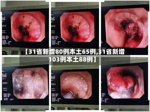 【31省新增80例本土65例,31省新增103例本土88例】-第3张图片