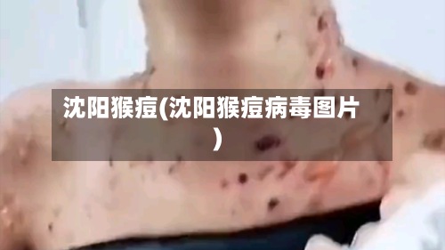 沈阳猴痘(沈阳猴痘病毒图片)